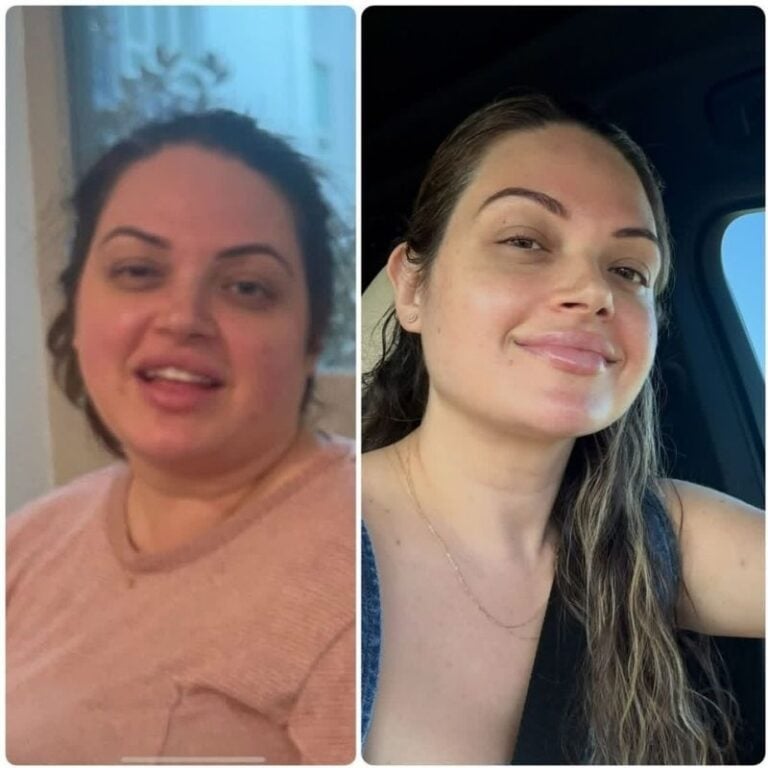 cortisol face before and after