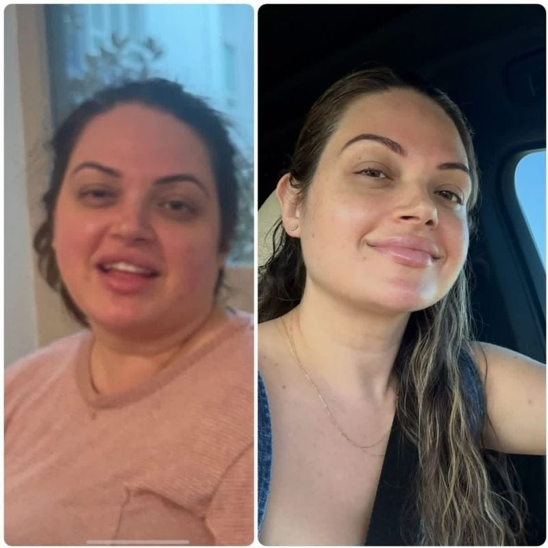 cortisol face before and after